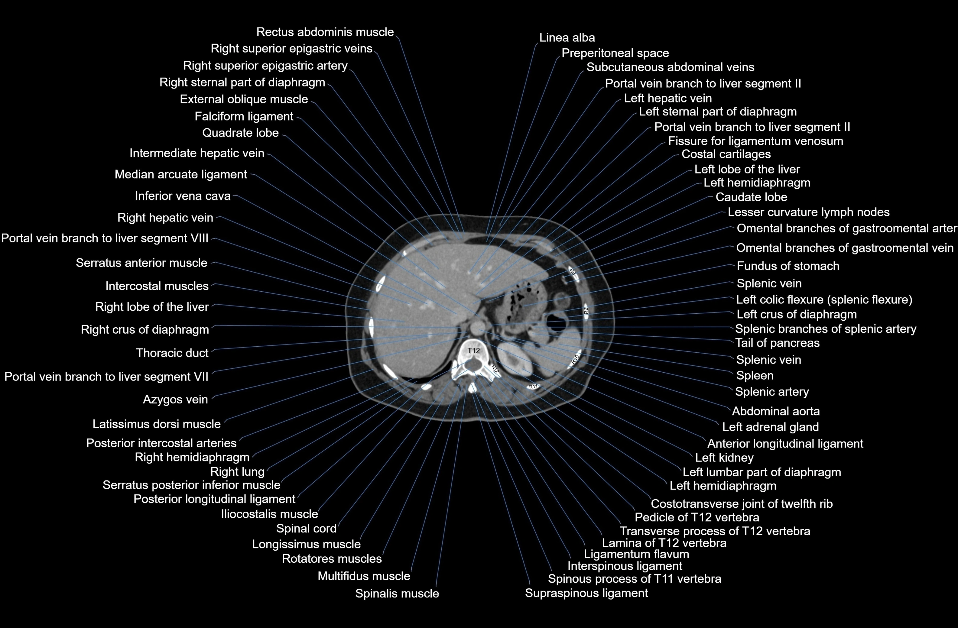 CT Abdomen axial cross sectional anatomy labelled radiology image-00018.webp